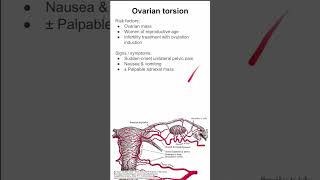 Ovarian torsion [upl. by Eki93]