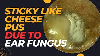 STICKY Like Cheese Pus Due To Ear Fungus [upl. by Tudor]