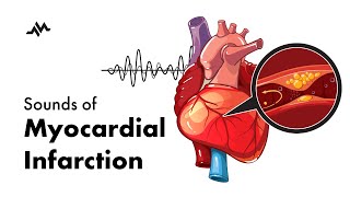 Sounds of Myocardial Infarction [upl. by Ykciv]