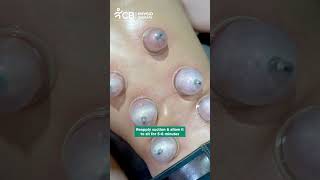 Wet Cupping Therapy  Hijama for Back Pain  CB Physiotherapy [upl. by Rehtse]