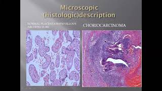 Histology of Choriocarcinoma [upl. by Stelle50]