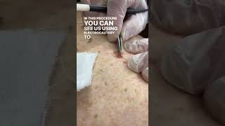 Seborrheic Keratosis Removal [upl. by Abihsot]