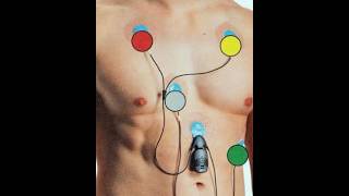 Holter monitoring II noninvasive procedure II cardiovascular disease II nursing II medical study II [upl. by Wolford]