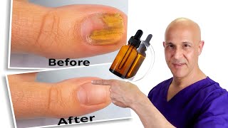 1 Oil Cures Toe Nail Fungus  Dr Mandell [upl. by Skiest]