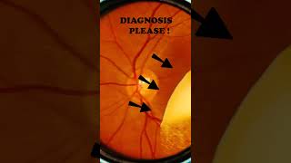 Diabetic retinopathy  Vitreous  Hard exudates  Fundus  Short Video 192 [upl. by Cerys515]