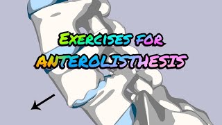 Exercises for ANTEROLISTHESIS [upl. by Itram]