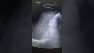 Hepatic calcification on USGcomedy usg trending baby usgsfactsviralvideoshorts youtubeshort [upl. by Homer]