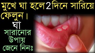 মুখের ঘা দূর করার উপায়mukhe gha hole ki korboমুখে ঘা হলে কি করবেনমুখের ঘা সারানোর উপায়। [upl. by Wemolohtrab]