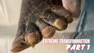 EXTREME FOOT TRANSFORMATION  PART 1 [upl. by Edik]