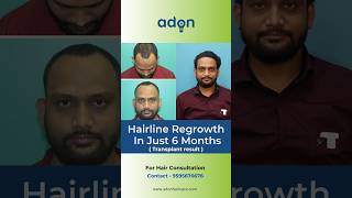 3000 grafts hair transplant result in 6 months  Best hair line  Adon Hair Care viralvideo [upl. by Kate]