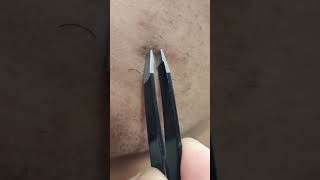 Satisfying Facial Hair Extraction with Tweezers HAIR PLUCKING tweezers [upl. by Shien]