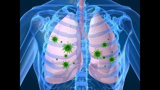 8 síntomas de la pulmonía que no puedes ignorar [upl. by Taddeo]