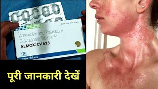 Almox cv 625 tablets benefits and side effects in hindi amoxycillin and potassium clavulanate 625 [upl. by Darin297]