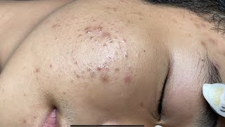 ACNE TREATMENT VU QUYNH MI Acne On Boys Chin 2024 [upl. by Solrac]