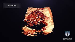 3DTHYROID® Thyroid Cancer Video Hard Nodule [upl. by Olivero]