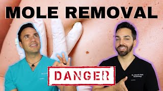 HOW TO REMOVE AN UNWANTED MOLE  DERMATOLOGIST PERSPECTIVE [upl. by Russell784]