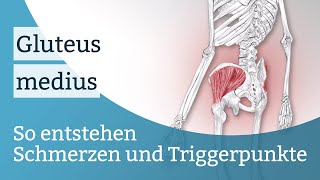 Gluteus medius Schmerzen Triggerpunkte und deren Aktivierung [upl. by Imoyn]