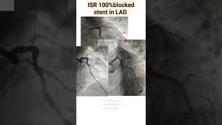 ISR instent restenosis l 100 blocked stent in LAD l Repeat Stenting done to LAD shorts [upl. by Bedad224]