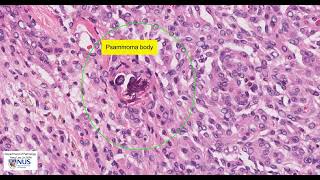 Meningioma meningothelial microscopy  Talking slide [upl. by Asined]