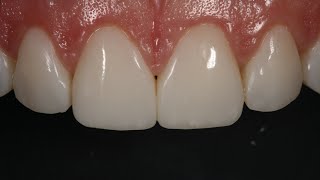 Resin Veneering and Freehand Diastema Closure [upl. by Bernie]