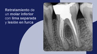 Retratamiento de un molar inferior con lima separada y lesión en furca [upl. by Colet351]