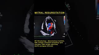 Mitral Regurgitation mitralvalve mitral mitraclip aorta aortic atrial atrialfibrillation [upl. by Ahsikcin213]