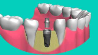 Si vous avez subi la perte dune dent Implant dentaire est la meilleure solution [upl. by Alyce]