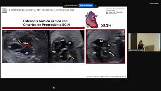 TRATAMIENTO FETAL DE CARDIOPATIAS CONGENITAS [upl. by Aicnorev]