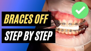 BRACES OFF  Step by step orthodontic removal [upl. by Ainak]