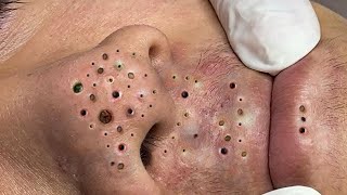 Big Cystic Acne Blackheads Extraction Blackheads amp Milia Whiteheads Removal Pimple Popping  4461 [upl. by Elsilrac]