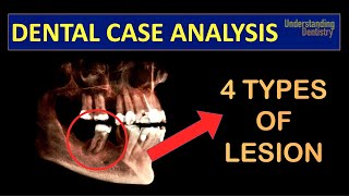 TRY TO DIAGNOSE A Case with 4 TYPES of PERIAPICAL LESIONS radicular cyst close to IAN Dental Quiz [upl. by Eserrehs]