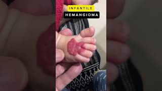 Infantile Hemangioma hemangioma infants treatment [upl. by Carlson]