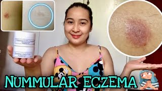 HOW TO TREAT NUMMULAR ECZEMA PHILIPPINES [upl. by Au81]