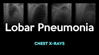 Lobar Pneumonia Chest Xray Images [upl. by Imnubulo492]