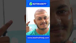 This Hair Transplant Result Will Blow Your Mind 🔥🔥🔥 hairtransplantresult [upl. by Landes713]