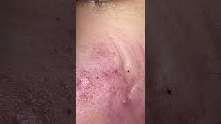 Blackheads Removal  Acne Treatment and Very Satisfying Satisfying Pimple pop blackheads [upl. by Sabelle]