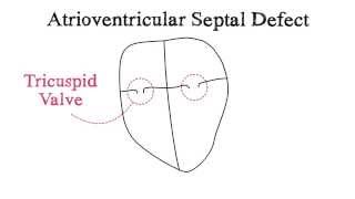 Atrioventricular Septal Defect AVSD [upl. by Goldarina]