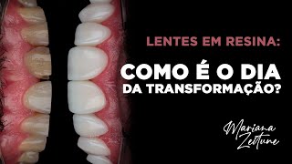 Lentes em Resina Composta Como é o dia da transformação do sorriso Por Dra Mariana Zeitune [upl. by Ursulette270]