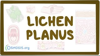 Lichen planus  causes symptoms diagnosis treatment pathology [upl. by Broucek]