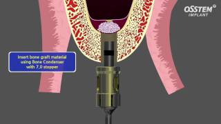 Internal Sinus Lift [upl. by Bove]