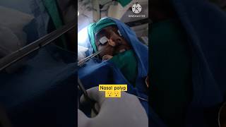 nasal polypent noseshortsshortvideo ytshorts remove [upl. by Notsecnirp618]