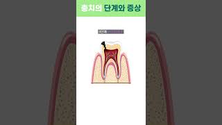 🦷 충치 단계와 증상 🦷 👇자세한 건 캡션 확인👇 리셋치과 shorts short [upl. by Oicelem]