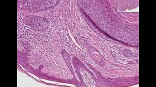 Histopathology Skin lipBasal cell carcinoma [upl. by Ihsakat]