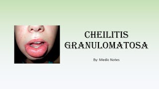 Cheilitis granulomatosa  causes signs amp symptoms investigation treatment [upl. by Lleirbag387]