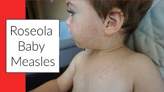 ROSEOLA  BABY MEASLES  SIGNS amp SYMPTOMS  RASH [upl. by Southard]