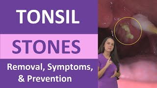 Tonsil Stones Removal Causes Symptoms Cotton Swab Treatment [upl. by Reinal]