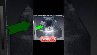 Cystitis  Foley Catheter in situ  Thick walled U Bladder on Ultrasound [upl. by Siul]