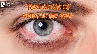 How do I get rid of the orangered circle of veins in my eye  Dr Sriram Ramalingam [upl. by Reywas]