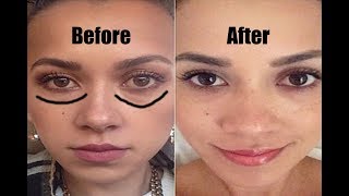 Get Rid Of Eye Bags Permanently in 1 Month  Most Effective Ways To Remove UNDER EYE BAGS [upl. by Jessa]