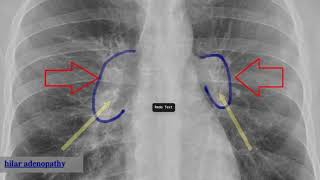 bilateral hilar adenopathy [upl. by Ahsit]